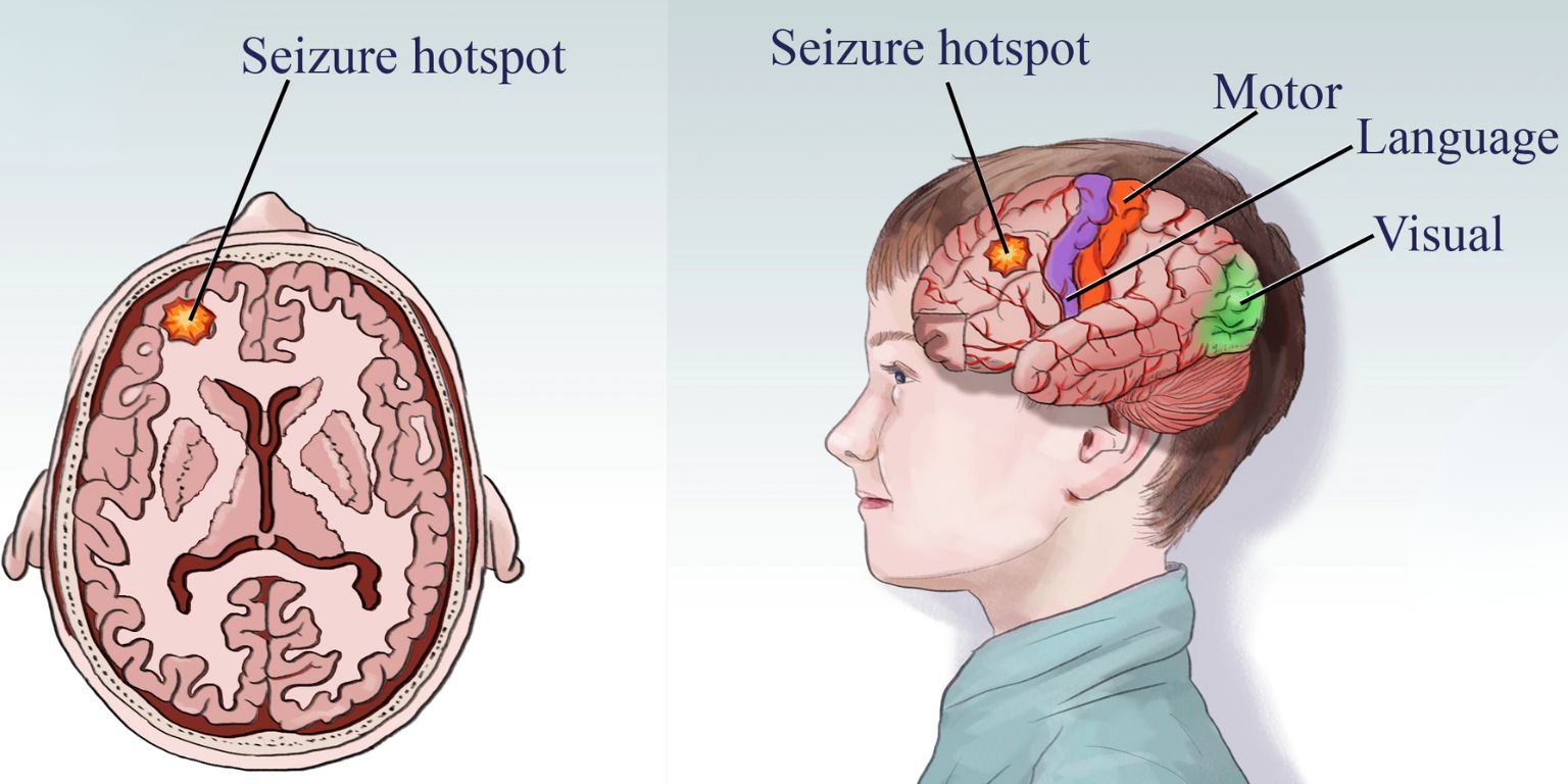 Dr. Patnaik's Brain Spine & Heart Care Centre - Epilepsy | Dr. Pavitra Patnaik